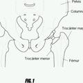 Ilustración 4 de Sistemas de cirugía de la cadera.