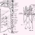 Ilustración 2 de Aparatos de catéter que tienen estructuras de malla expansibles para neuromodulación renal.