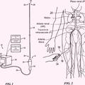 Ilustración 4 de Aparatos de catéter que tienen estructuras de malla expansibles para neuromodulación renal.