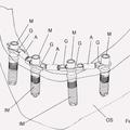 Ilustración 4 de Aparato modular para la instalación de prótesis dentales múltiples