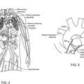 Ilustración 3 de Aparatos de catéter para la modulación de nervios en comunicación con el sistema pulmonar y sistemas asociados.