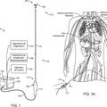 Ilustración 4 de Aparatos de catéter para la modulación de nervios en comunicación con el sistema pulmonar y sistemas asociados.