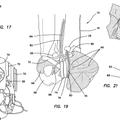 Ilustración 3 de Modelo de hernia.
