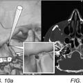 Ilustración 2 de Tratamiento del dolor de cabeza por inyección de sustancia neuroinhibidora al ganglio esfenopalatino o al ganglio ótico