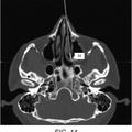 Ilustración 3 de Tratamiento del dolor de cabeza por inyección de sustancia neuroinhibidora al ganglio esfenopalatino o al ganglio ótico.