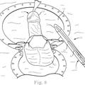 Ilustración 2 de Prótesis de pene, herramienta de inserción de prótesis de pene y sistema del mismo.